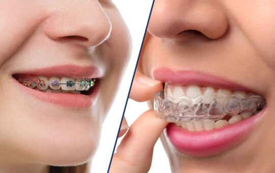 braces vs aligners